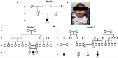 Whole Exome Sequencing Identifies Three Novel Mutations in the ASPM Gene From Saudi Families Leading to Primary Microcephaly
